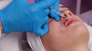 Коррекция носослезной борозды , губ и носогубной складки филлерами Stylage