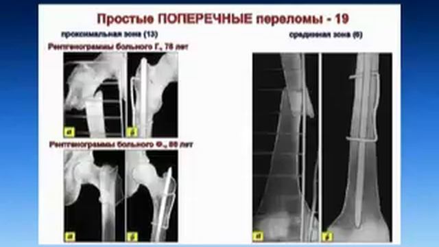 Остеосинтез бедренной кости с применением фиксаторов с термомеханической памятью смотреть онлайн