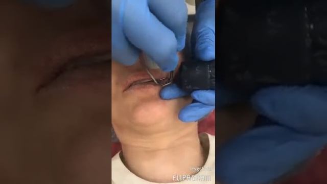 Лазерное омоложение губ "Лазер Тинт" смотреть онлайн