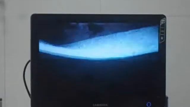 Дергачевская ЦРБ Лечение пупочной грыжи смотреть онлайн