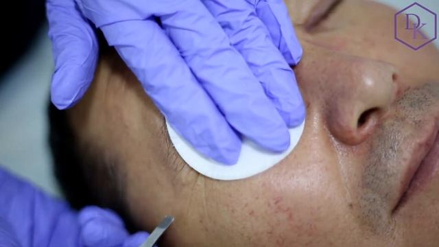 снятие швов после круговой блефаропластики