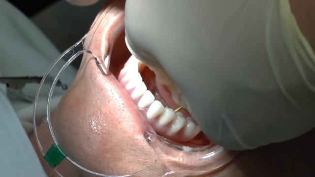 All on 4 Bridge Insert - DENTAL IMPLANTS смотреть онлайн