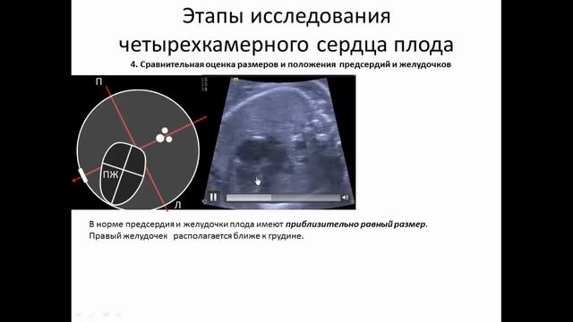 Ультразвуковая анатомия сердца плода (II-III триместры) смотреть онлайн