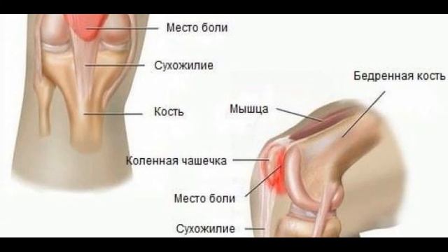 ✅ Болят колени что делать. Болят колени чем лечить. Колено опухло и болит смотреть онлайн