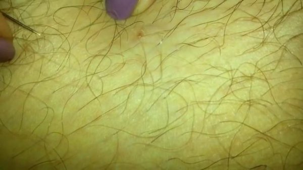 вросший волос / ingrown hair