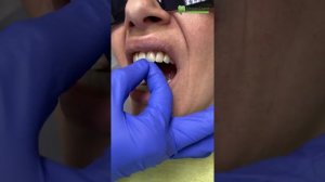 Установка готового полного съемного протеза. Часть 4