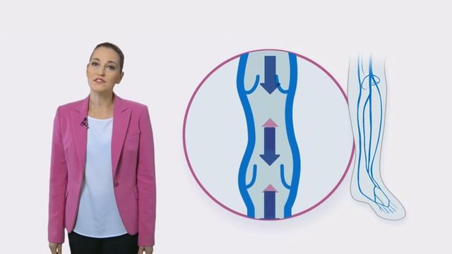 Хроническая венозная недостаточность смотреть онлайн