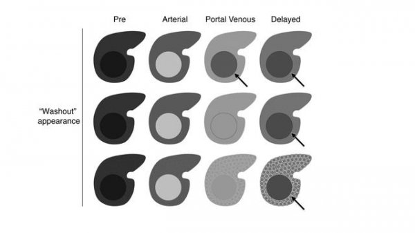 LI-RADS Radiology 2018 Jan