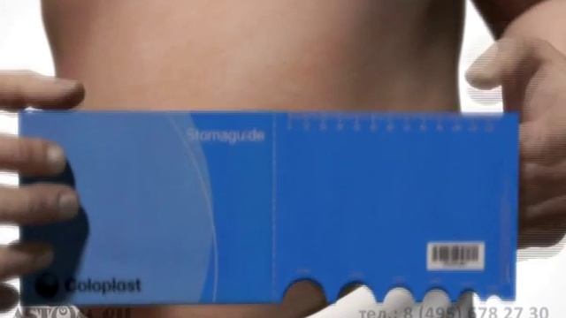 Уход за колостомой.Подготовка калоприемника к приклеиванию. смотреть онлайн