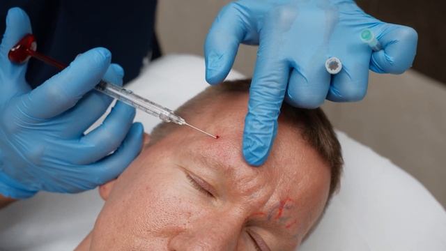 Коррекция верхней трети лица филлером Neauvia Stimulate