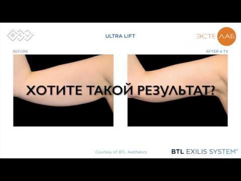 Похудение рук за 4 процедуры BTL EXILIS 360 смотреть онлайн
