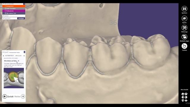 EXOCAD 2017 TUTORIAL - TEASER -Eierschalenprovisorium 34-36 modellieren смотреть онлайн
