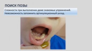 Дизартрия и ее признаки в артикуляции.