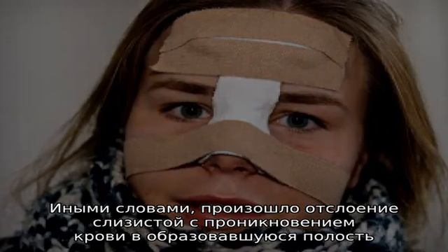Как проявляется и чем грозит ушиб носа смотреть онлайн