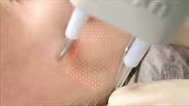 Лазерное омоложение ДОТ (Дермальный Оптический Термолиз) смотреть онлайн