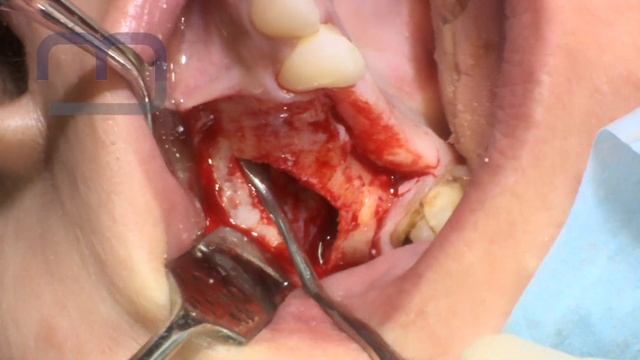 SINUS LIFT and CONTEXTUAL IMPLANT POSITIONING смотреть онлайн