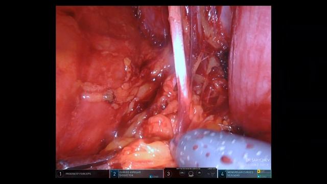 Robotic Radical Prostatectomy Part 7.0 Lymph Node Dissection смотреть онлайн