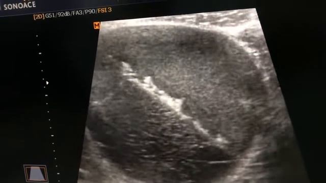 Endometriotic cyst or dermoid cyst смотреть онлайн