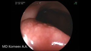 Ректороманоскопия 0 IIa прямой кишки  Эндоскопист Корнеев А А