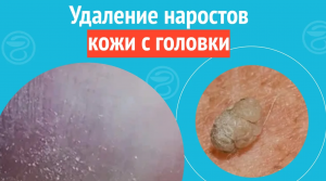 ✅ Удаление наростов кожи с головки. Клинический случай №1246