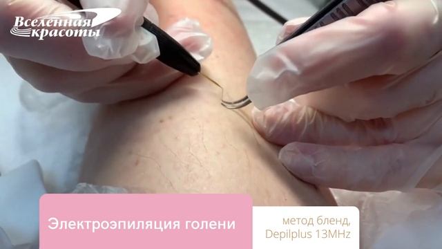 Электроэпиляция голеней методом blend смотреть онлайн