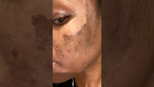 Best Chemical Peel For Dark Skin