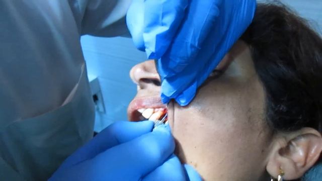 Dental implant done by Dr Kapil Mahajan смотреть онлайн