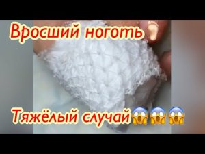 Вросший ноготь??• Тяжёлый случай???
