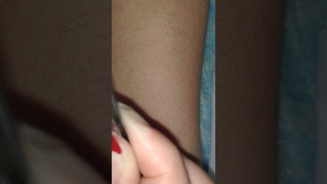 1200W diode laser treatment смотреть онлайн