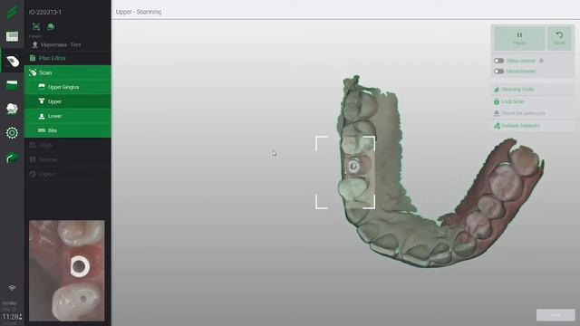 How to scan dental implant with Straumann - Virtuo Vivo Intraoral Scanner смотреть онлайн