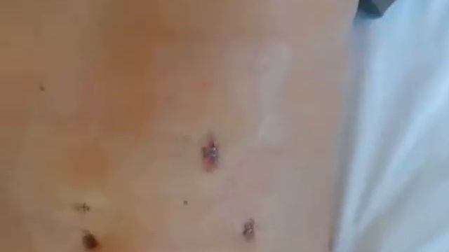 Лапароскопическая герниопластика грыжи белой линии живота. Владивосток ДВФУ 09 02 2021 Часть 4 смотреть онлайн