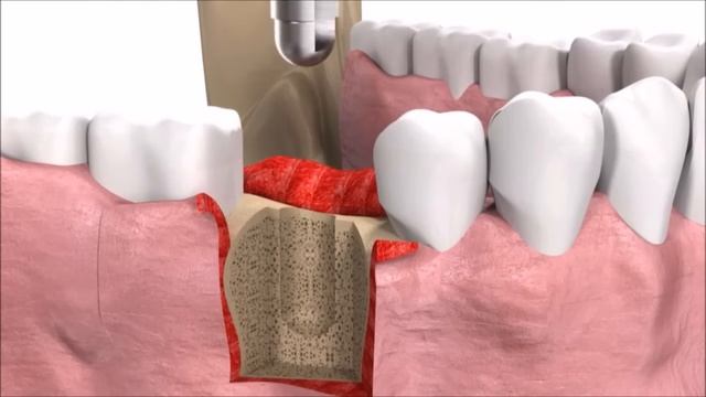как ставят имплант смотреть онлайн