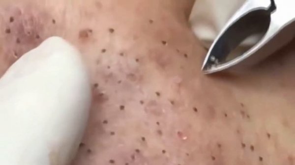 Много мелких прыщиков/Давить прыщи/Relax Every Day ?