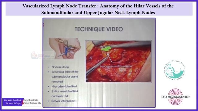 49 Vascularized Lymph Node Transfer Anatomy of the Hilar Vessels of the Submandibular and Upper Ju смотреть онлайн