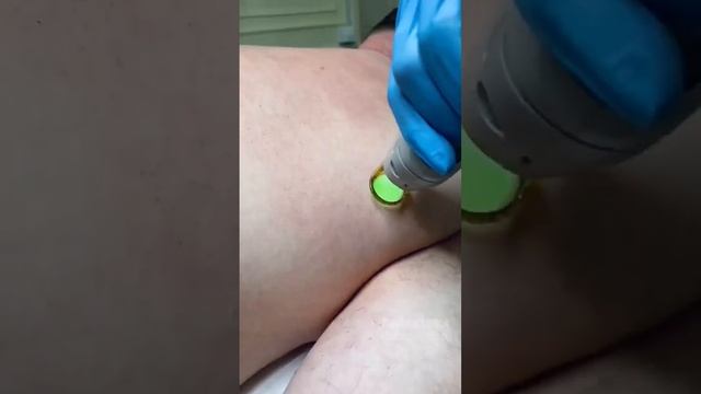 Лазерная эпиляция на аппарате #GentleLase Pro #shortsvideo #shorts #косметология #косметолог смотреть онлайн