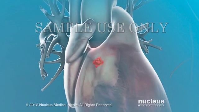 About Your Heart Attack