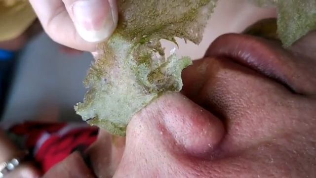 Blackhead Removal Using Mask In Asia/Blackheads Removal