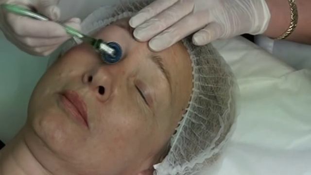 Сочетание - нидлинг, ботокс и контурная пластика смотреть онлайн