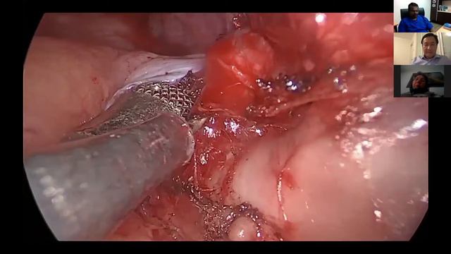 International Webinar On Surgical Treatment Of Complex Thoracic Tumors Sponsored By Panther