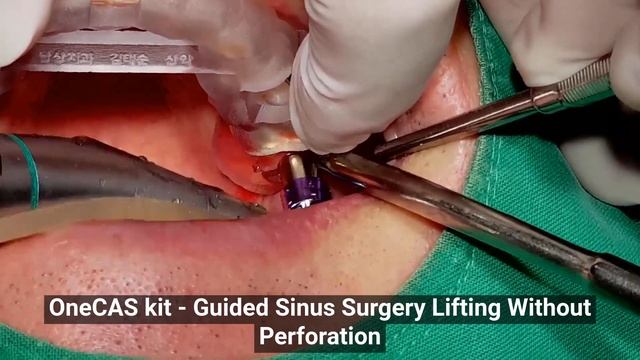 Digital Guided Crestal Approach Sinus Lift Surgery using Osstem OneCAS Kit смотреть онлайн