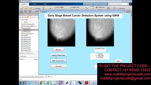 Early Stage Breast Cancer Detection System using GMM смотреть онлайн