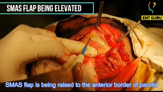 pleomorphic adenoma surgery смотреть онлайн