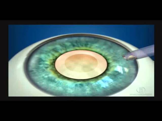Катаракта. Удаление катаракты. Факоэмульсификация смотреть онлайн