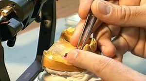 Изготовление мостовидного протеза на 2 имплантах