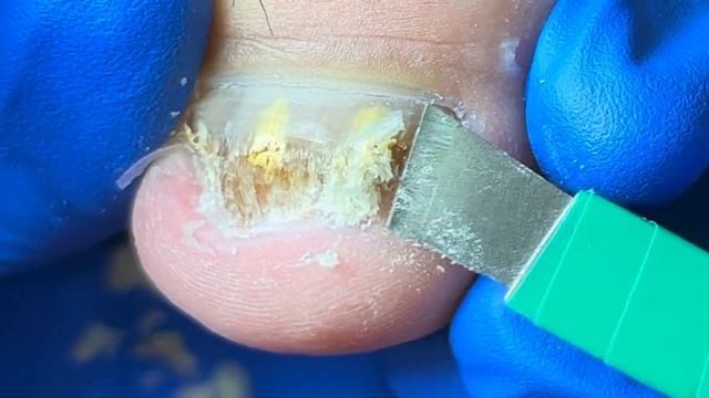 Pedicure Tutorial: Repair Ingrown Nails And Relieve Pain!【Xue Yidao Pedicure】