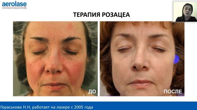 Лазерный импульс 650 микросекунд: возможности, эффекты, преимущества смотреть онлайн