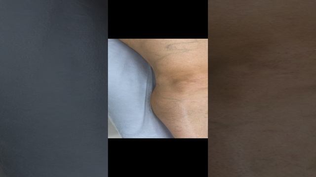 Лечение варикоза лазером. Результат. Узи сосудов. Узи вен. Сосудистый хирург. Флеболог Москва смотреть онлайн