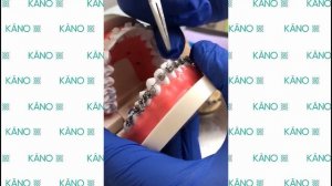 Что делать, если открылся замочек брекета?