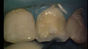 Реставрация зубов.Прямая композитная реставрация переднего резца.