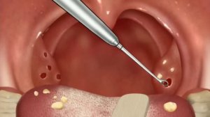 АЅMR] Причина неприятного запаха изо рта! Анимация удаления камней миндалин